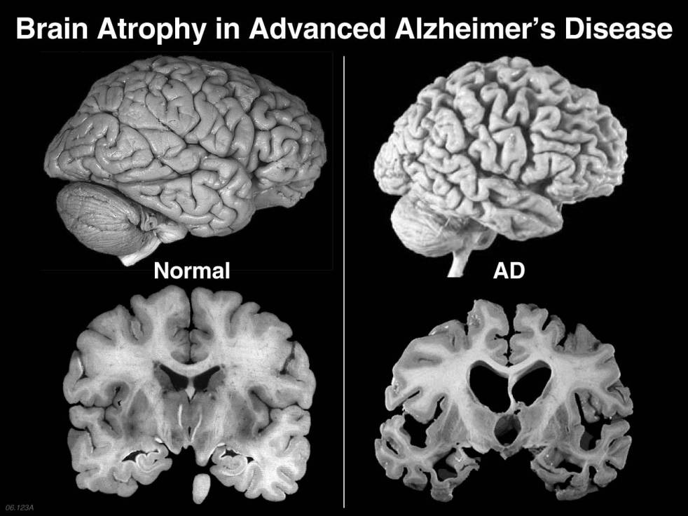 Mengenal Penyakit Alzheimer